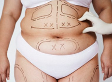 Cresce número de cirurgias bariátricas no país, de acordo com SBCBM