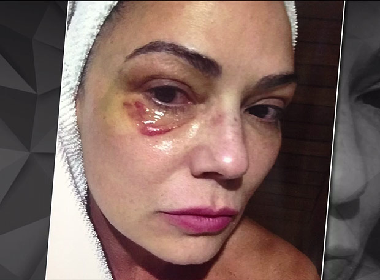 Após foto de agressão, promotor do caso Luiza Brunet diz não ter dúvidas da agressão