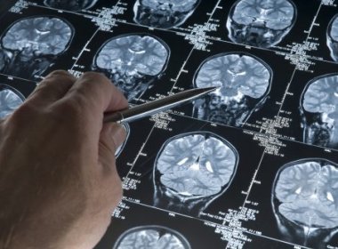 Dia Roxo: Visões e cheiros também podem representar sintomas de epilepsia