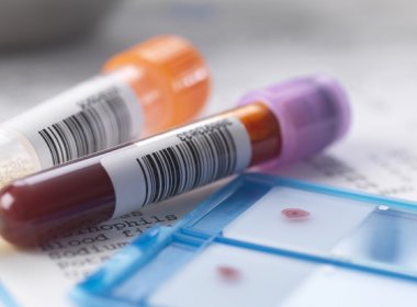 Teste rápido de infecção pelo vírus da hepatite é incluído na tabela SUS