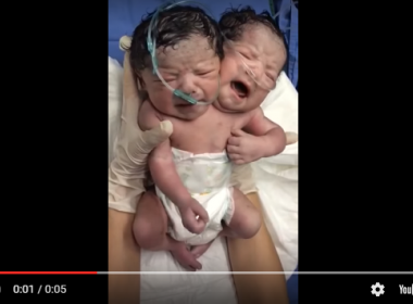 Bebê com duas cabeças nasce no México; vídeo mostra primeiros momentos