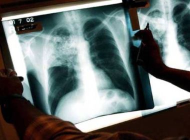 Salvador é 3ª capital em casos de tuberculose; 14 mortes foram registradas neste ano