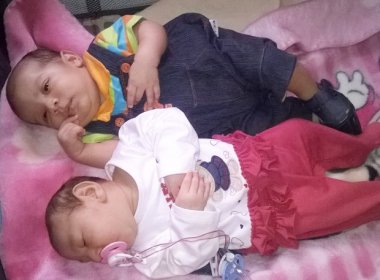 Menina nasce com microcefalia e irmão gêmeo, não; USP estuda caso